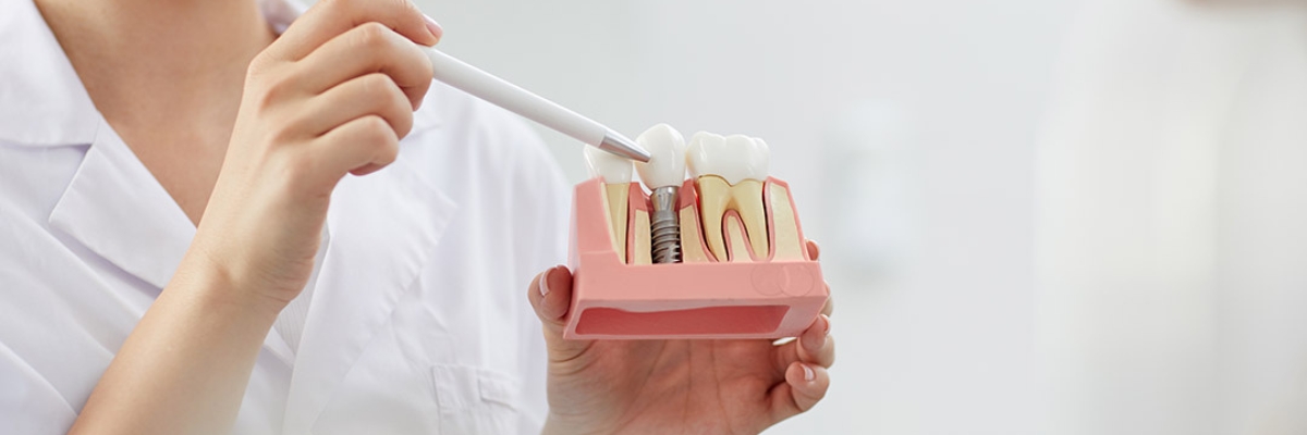 Dental Implants New York – The Ultimate Guide